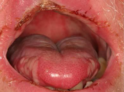 <p><strong>generalized</strong> ulceration following cancer treatment </p>