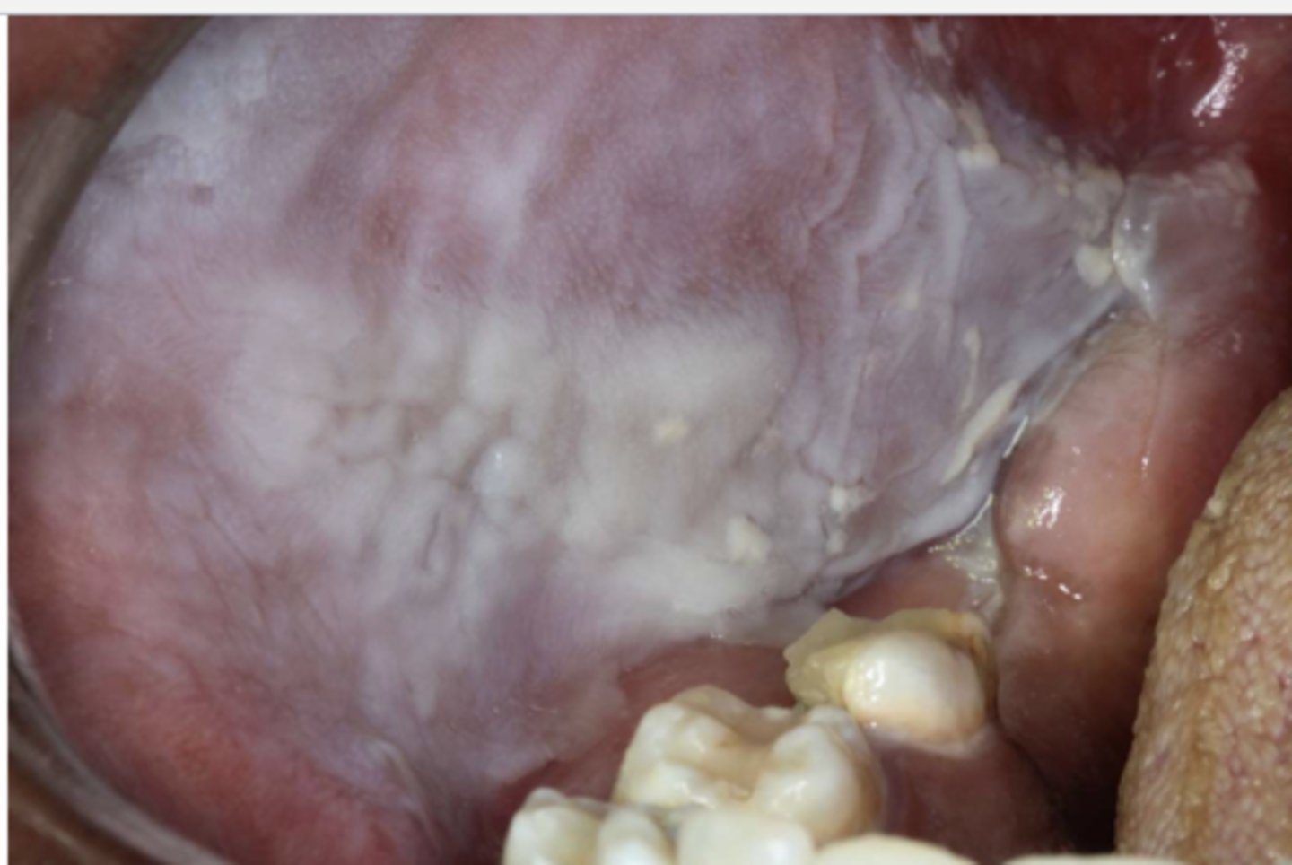 <p>Patient reported that they have multiple minor headaches per week and take a 500mg Aspirin as needed to relieve the pain. Patient reported being unable to swallow pills, so she sucks on the aspirin until it dissolves in her mouth. What do you suspect the white lesion encompassing her buccal mucosa is due to?</p>