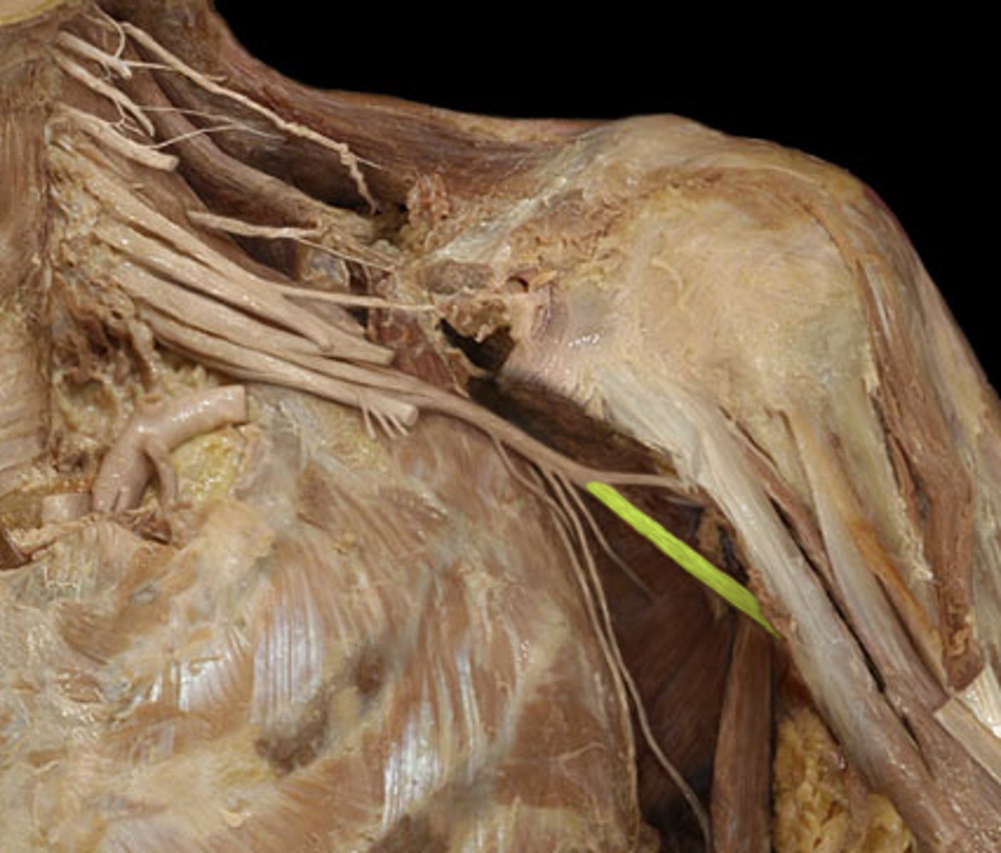 <p>Travels along with profunda brachii artery through radial/spiral groove, innervates posterior arm (triceps)</p>