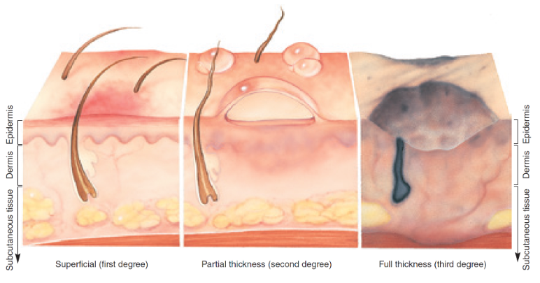 involves only the top layer of the skin, epidermis, skin turns red but does not blister or burn through top layer, ex: sunburn 