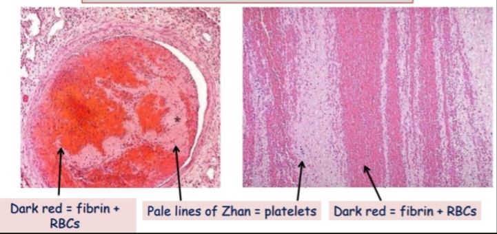 <p>microscopic picture of thrombus</p><p>1,3-Dark red areas represent fibrin + RBCs.</p><p>2- Pale lines represent lines of Zahn (platelets).</p>