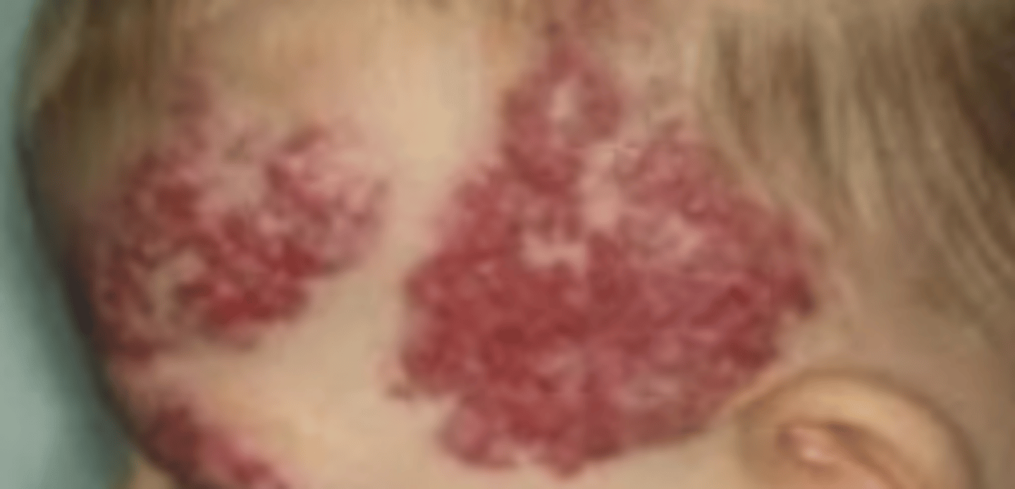<p>phacomatosis occurring due to an autosomal dominant mutation in chromosome 3. Involves capillary hemangioma formation in the central nervous system and is associated with renal and pancreatic carcinoma. Ocular and genetic testing indicated.</p>