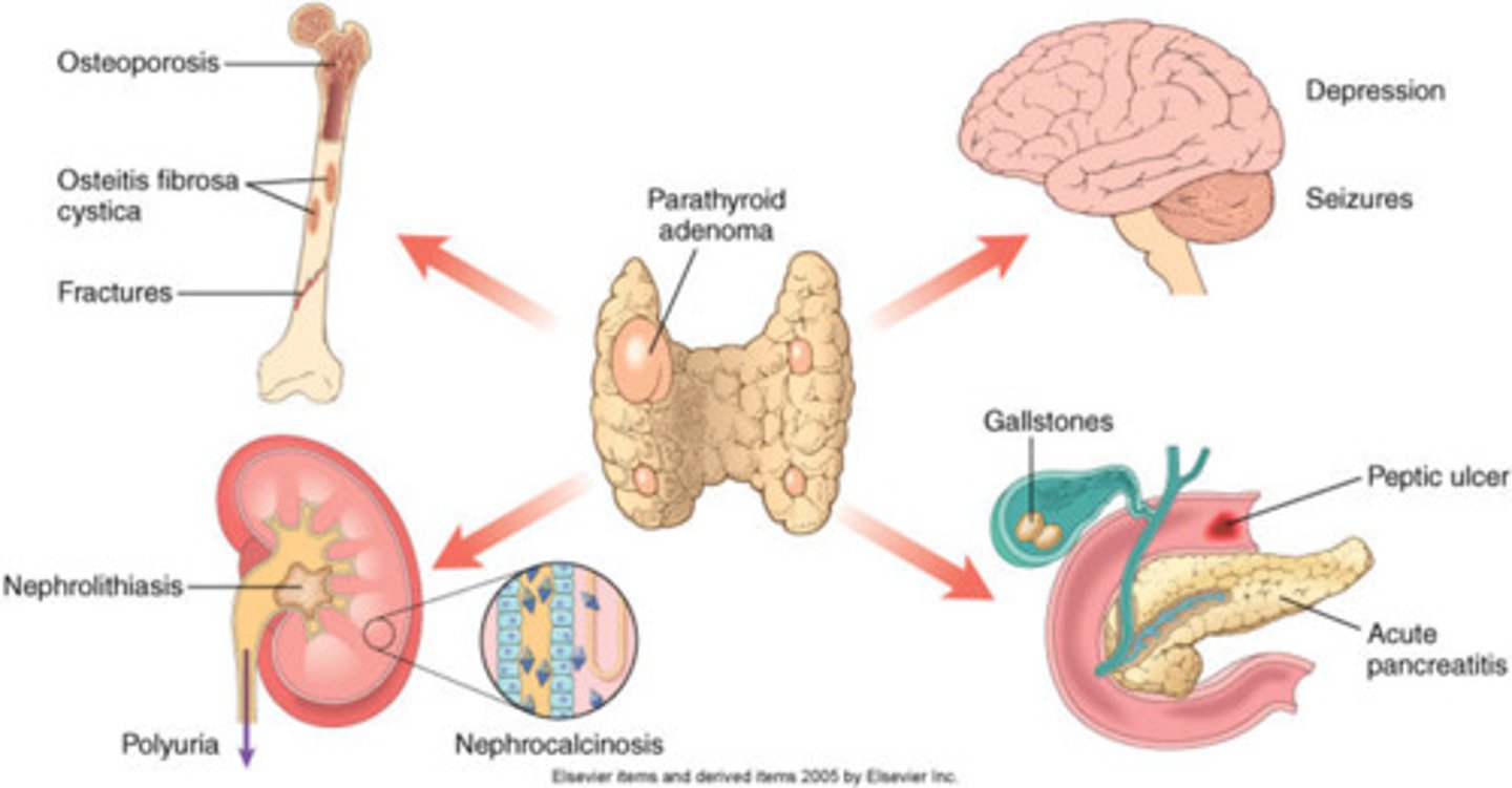 <p>- elevated PTH with elevated calcium = primary dz</p><p>- renal stones, polyuria</p><p>- HTN, constipation</p><p>- fatigue, mental changes</p><p>- bone pain, pathologic fx</p><p>"bones, stones, abdominal groans, psychic moans, with fatigue overtones"</p>
