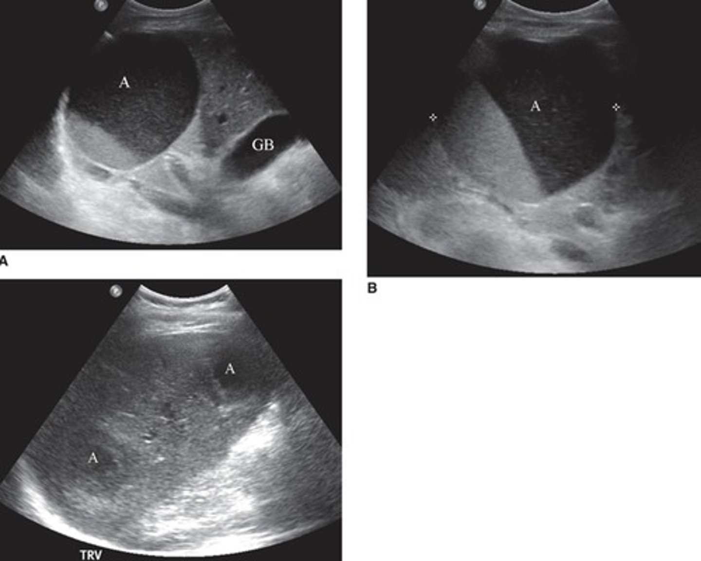<p>Localized infection with pus</p><p>Complex appearance</p><p>Will have fever/chills, pain, N/V, fatigue, hepatomegaly</p>