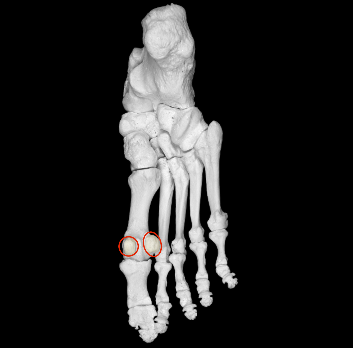 <p>additional bone on inferior of metatarsal I head </p>