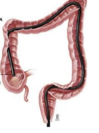 <p>visualize the entire colon looking for polyps, malignancy, diverticulitis, requires full sedation and cleanout</p>
