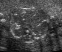 <p>Bowel obstruction has occurred in the fetus, and this was seen on the scan. </p><ol><li><p>What US finding is seen here?</p></li><li><p>What pathology is it an indication for?</p></li></ol><p></p>