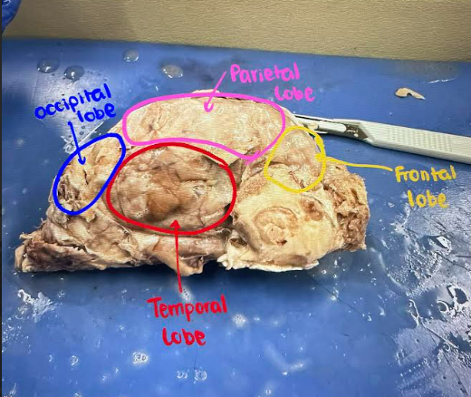 <p>x = cerebellum</p>