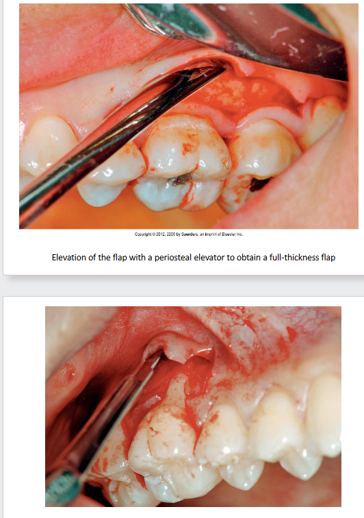 <p><strong>Purpose: to gain access to the root surface and bone</strong></p><p><strong>Flap:</strong> loosened portion of gingiva and alveolar mucosa that is separated from the underlying structures (except for its base because this is where the flap receives blood supply)</p><ul><li><p><strong>Full-thickness (mucoperiosteal) Flap: </strong>gingiva, alveolar mucosa, and periosteum are reflected from the root and underlying bone surface</p></li><li><p><strong>Partial-thickness (split) Flap:</strong> periosteum and some gingival connective tissue are left attached to the bone and are not included in the reflected flap</p></li></ul><p>.</p><p><strong>Types of Surgical Flap Procedures:</strong></p><ul><li><p>Pocket Reduction</p><ul><li><p><strong>apically-positioned flap</strong></p></li></ul></li><li><p>Bone Graft</p><ul><li><p><strong>coronally-positioned flap</strong> (attempt to cover surgical site after placement of a bone graft)</p></li></ul></li><li><p>For Improved Periodontal Debridement &amp; Reduction in Inflammation and Pocket Depths</p><ul><li><p><strong>Modified Widman Flap </strong>(conservative surgical approach with no osseous contouring that better preserves esthetics in mx. ant.)</p></li></ul></li></ul><p>.</p><p><strong>Healing</strong></p><ul><li><p>tissues look healed within a few weeks</p></li><li><p><strong>complete tissue maturation is complete in 1-2 months</strong></p></li></ul><p></p>
