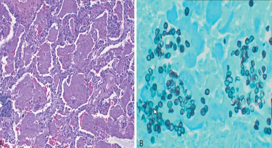 <ul><li><p>Occurs in <strong>AIDS</strong> patients because they are very vulnerable</p></li><li><p>Caused by <strong>Pneumocystis jirovecii</strong></p></li><li><p>Characterized by <strong>pink frothy intraalveolar exudate</strong> and rounded-to-<strong>cup-shaped cysts with a central dimple</strong> → seen using silver stain</p></li></ul><p></p>