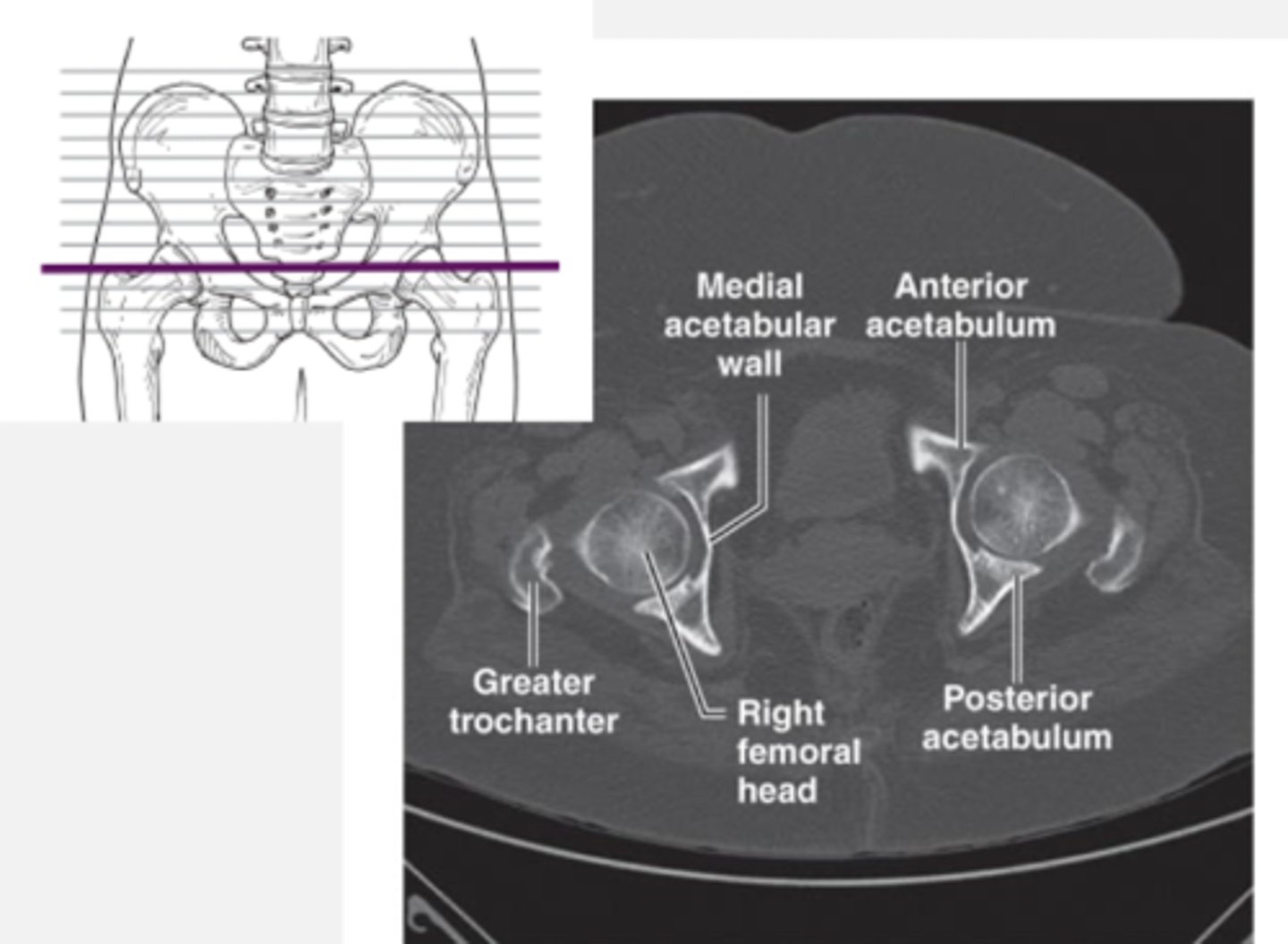 <p>- femoral head in acetabular fossa<br>- sacrum<br>- greater and lesser trochanter</p>