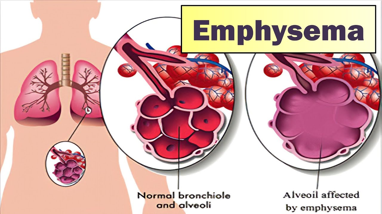 <p>emphysema</p>