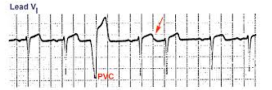 <p>-Ectopic beat with an abnormally wide and long QRS complex</p><p>-Abnormal morphology</p><p>-Premature </p>