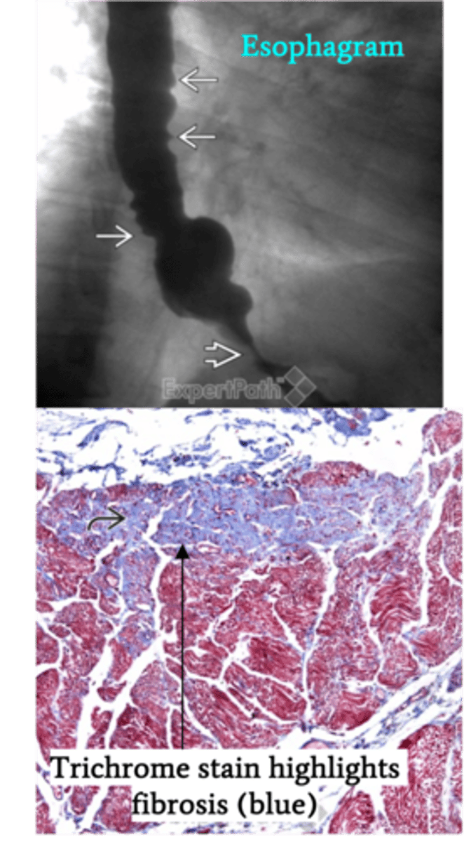 <p>Define Condition:</p><p>Systemic disorder characterized by vasculitis and upregulated collagen deposition --&gt; Hard thickening or tight skin ==&gt; Achalasia-type of Sx​</p><p>-Hx:</p><p>&gt; 90% pts experience this issue</p><p>-Path: Esophageal smooth muscle atrophy and fibrosis​ --&gt; ↓LES pressure and distal esophageal dysmotility --&gt; acid reflux and dysphagia -&gt; stricture</p><p>-Sx/PE:</p><p>&gt; Dysphagia</p><p>&gt; GERD</p><p>&gt; Assoc Sx = (think "CREST")</p><p>&gt;&gt; Calcinosis</p><p>&gt;&gt; Raynaud's Phenomenon</p><p>&gt;&gt; Esophageal Issues</p><p>&gt;&gt; Sclerodactyly</p><p>&gt;&gt; Telangiectasias</p><p>-Dx: Barium Swallow</p><p>&gt; May see Stricture</p>