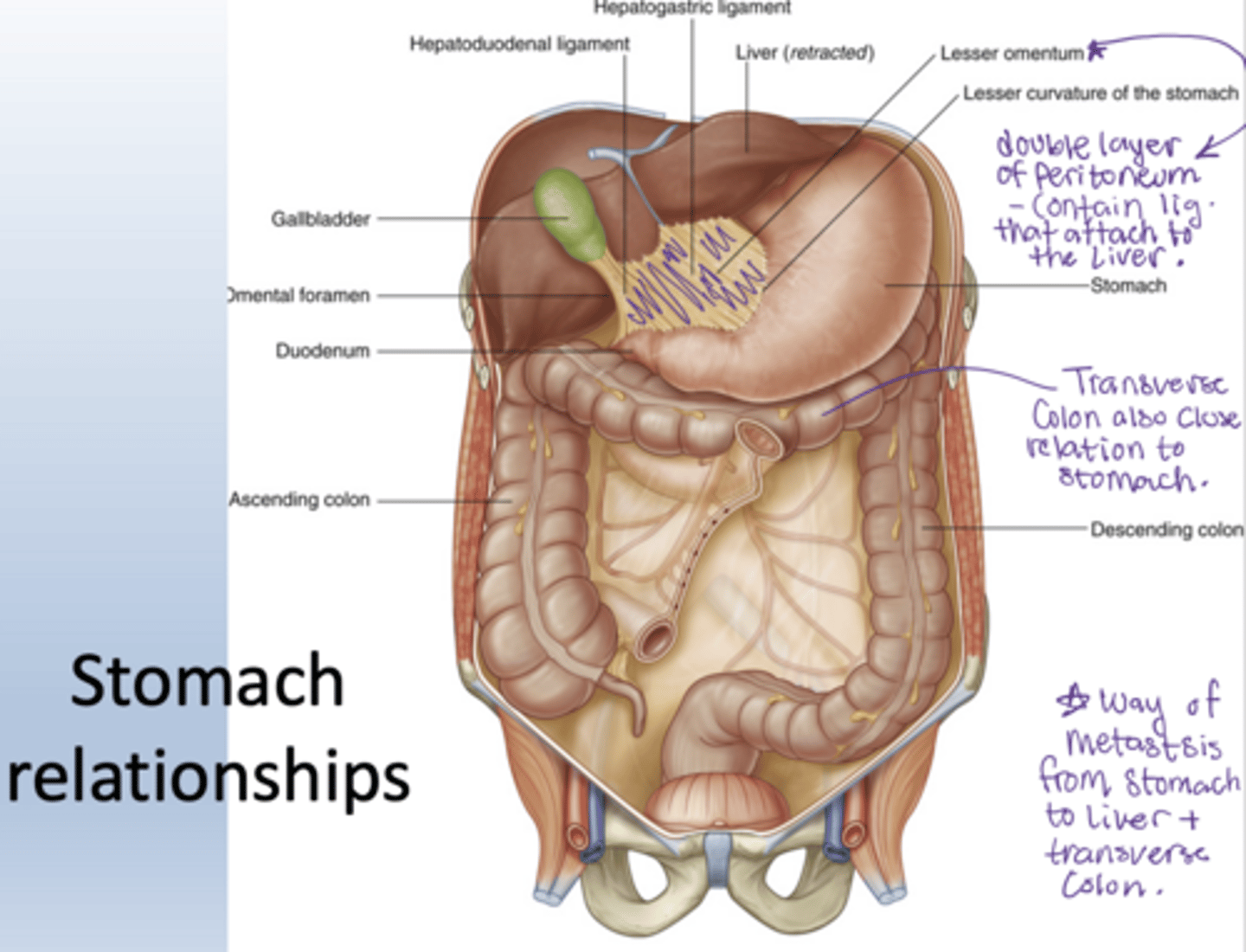 <p>pancreas, transverse colon, liver</p><p>way of metastsis from stomach to liver and TRC (pancreas mainly with ulcers)</p>