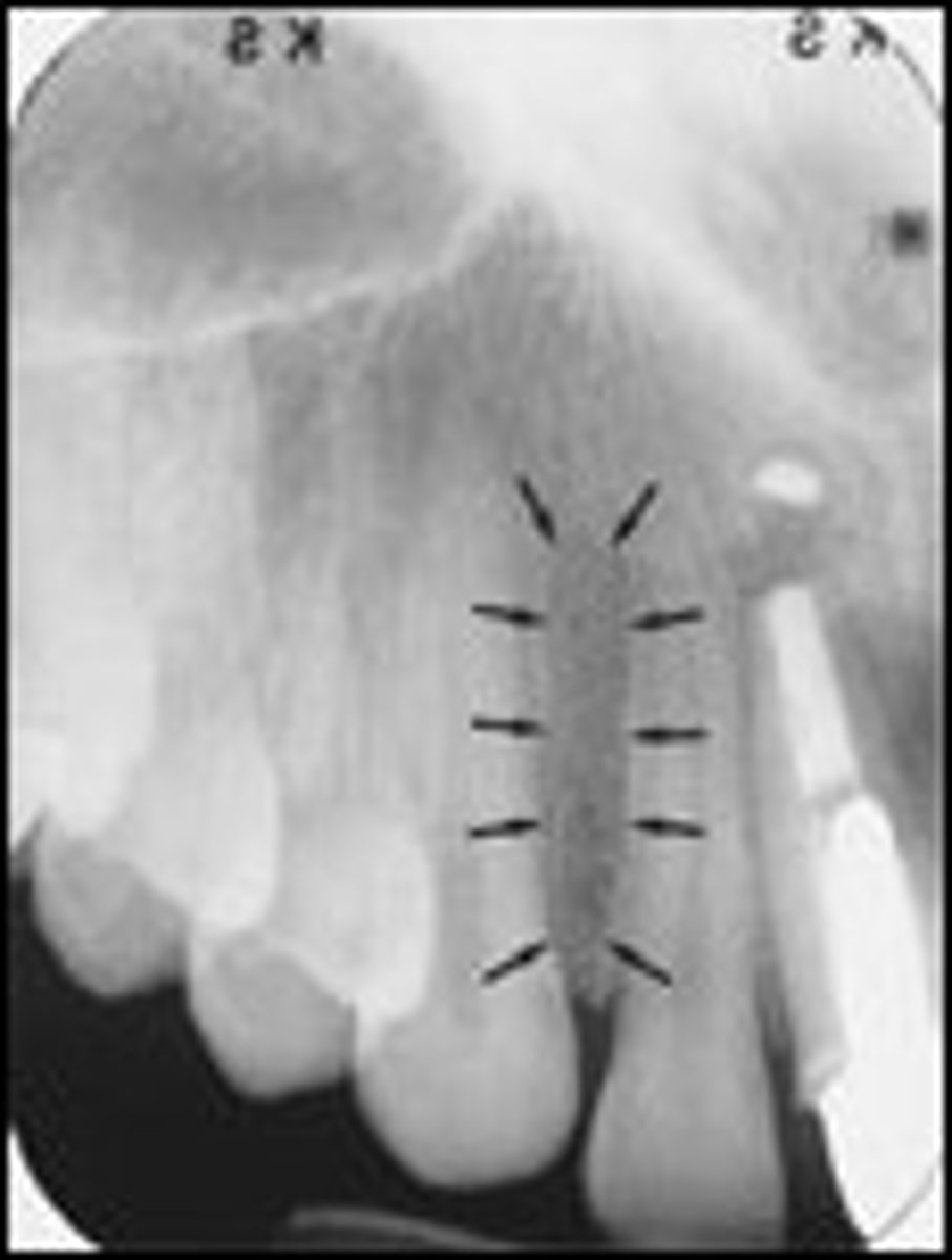 <p>A radiolucent area between the maxillary canine and lateral incisors</p>