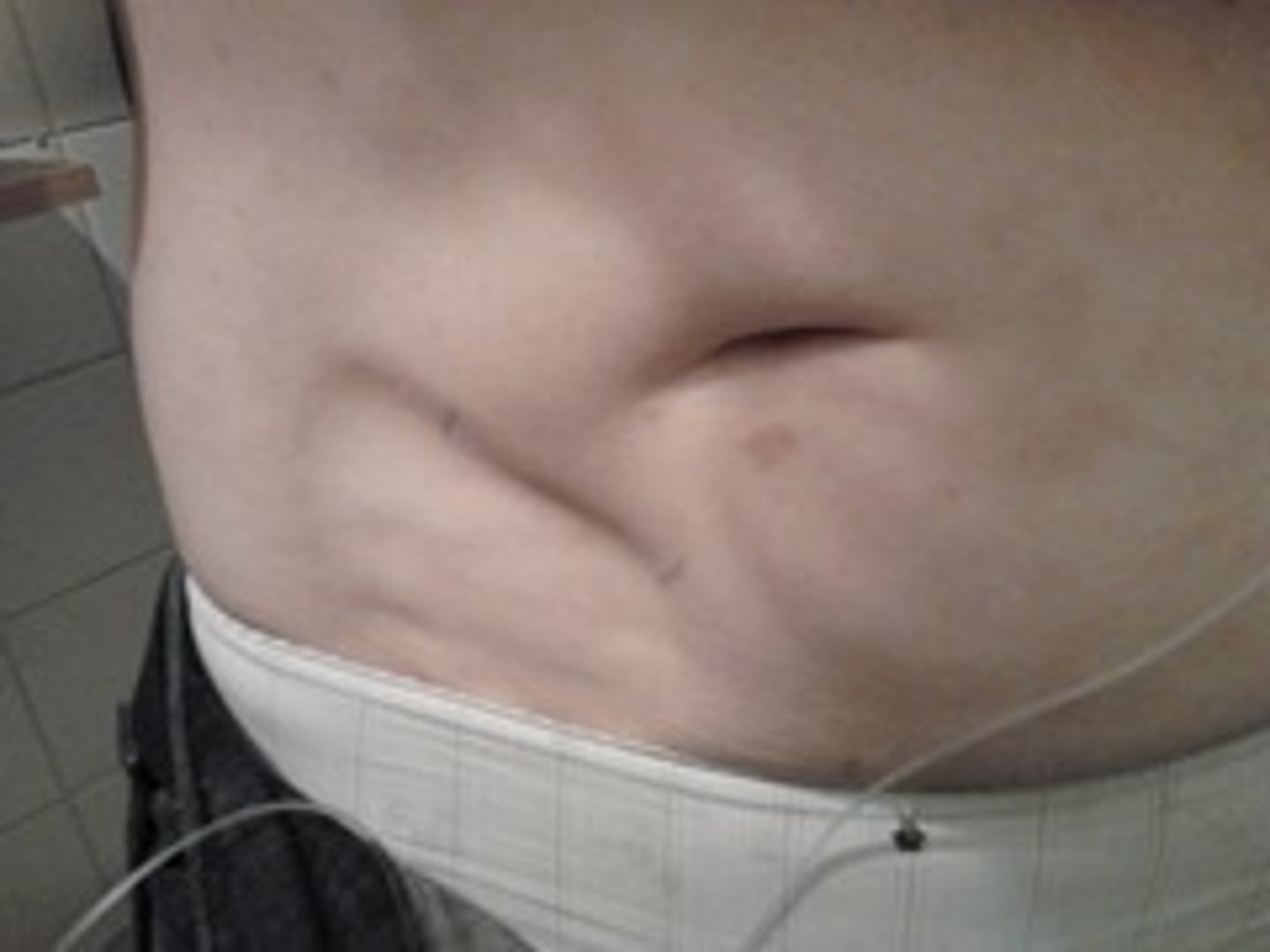 <p>atrophy of subcutaneous tissue (lumps)</p>