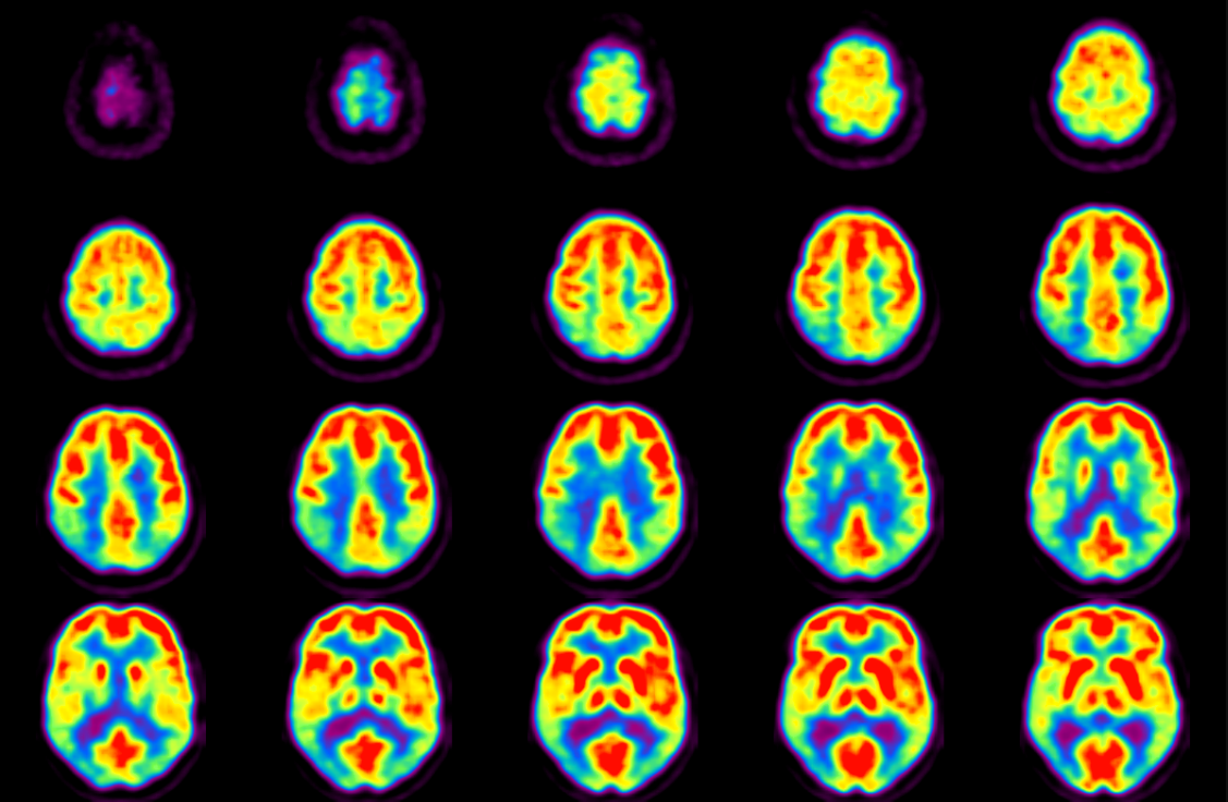 <p>emission; active/inactive parts of the brain</p>