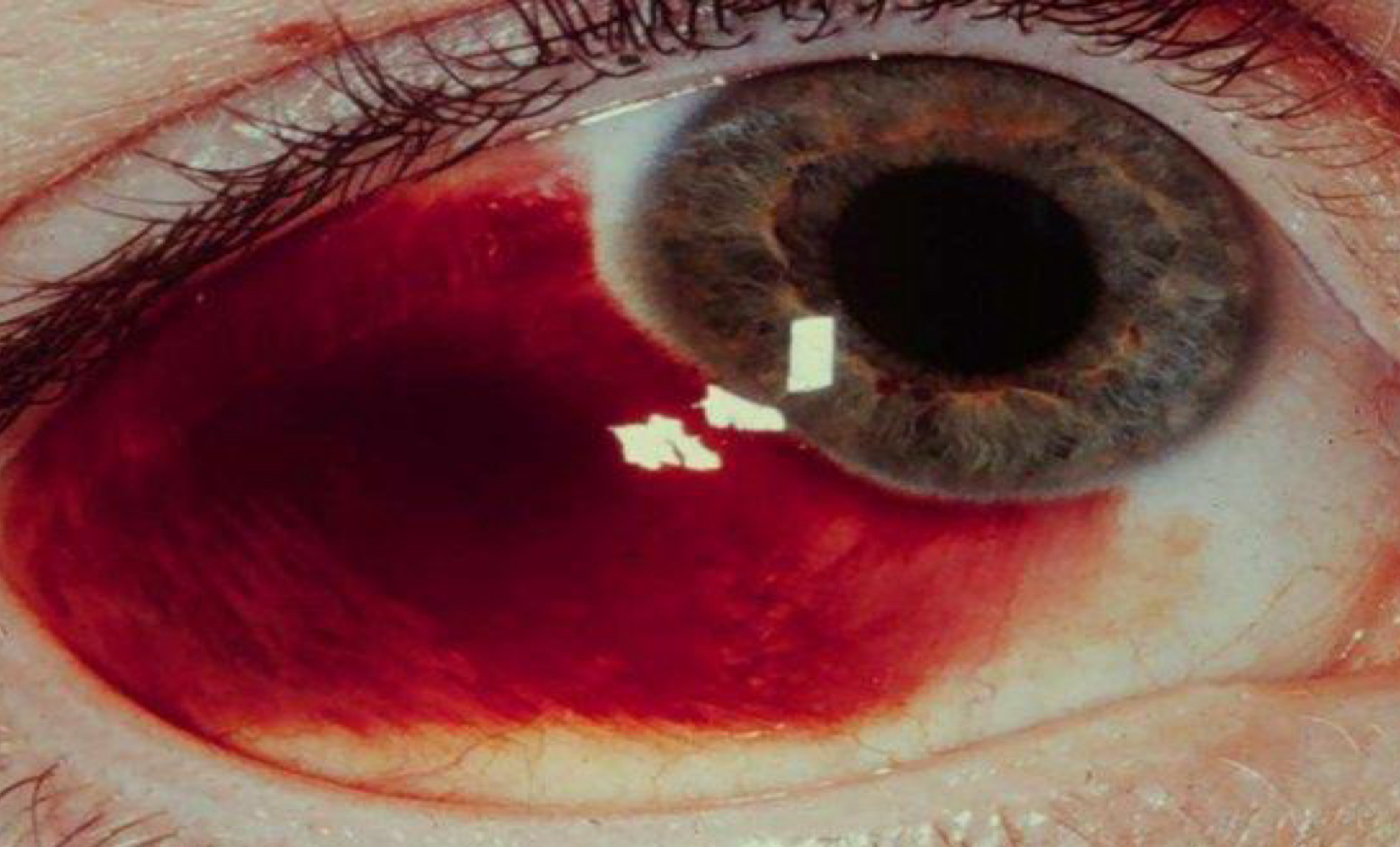 <p>What ocular complication is shown here? What type of injection has this as a complication?</p>