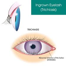 <p>PP: eyelashes growth inside of eyelid→irritate conjunctiva+lower cornea</p><p>E: <span>Congenital (present at birth)</span><br><span>Acquired (due to trauma, inflammation, or surgery)</span><br><span>Eyelid malformations</span><br><span>Trachoma (an infectious eye disease)</span></p><p>CM: lower eyelid in normal position</p>
