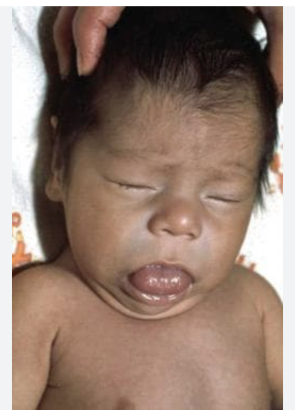 <p>A neonate born just now presents jaundice, puffy face, large tongue. Vitals are stable with the exception of 94.6 temperature. Physical exam shows hypotonia. Lab work shows low T3/4. What is your treatment plan?</p>