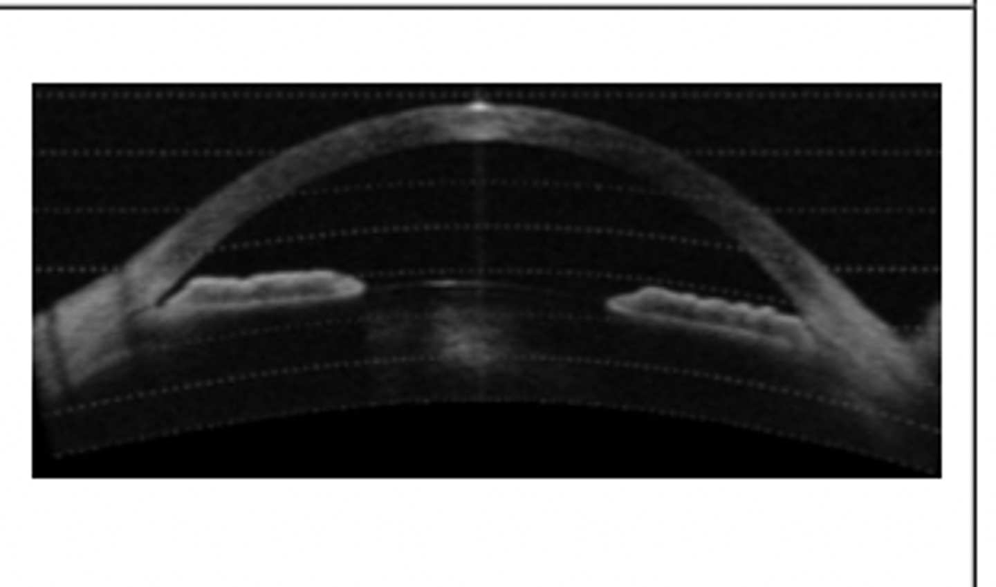 <p>1. deep anterior chamber</p><p>2. anteriorly positioned CB that mechanically supports the peripheral iris</p><p>3. angulated, sharp drop-off of the peripheral portion of the iris next to the angle wall</p>