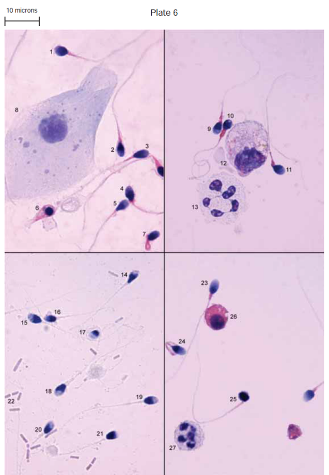 <p><span>§Papanicolaou Stain</span></p><p><span>§</span></p><p style="text-align: left"><span>8: Epithelial cells</span></p><p style="text-align: left"><span>12: Macrophage</span></p><p style="text-align: left"><span>13 / 27 : Leukocyte (WBC)</span></p><p style="text-align: left"><span>22: Bacilli</span></p><p style="text-align: left"><span>26: Spermatid (95% of round cells)</span></p><p style="text-align: left"></p><p style="text-align: left"><span>Giemsa Stain for Leukocyte determination</span></p>