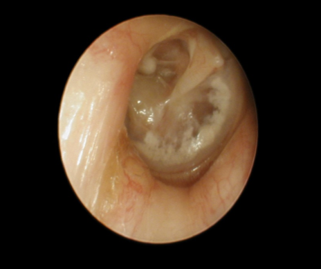 <ul><li><p>White plaques seen on the eardrum usually after repeated middle ear infections or after PE tubes</p></li><li><p>Plaques are caused by deposits of calcium in the tissue (collagen) of the tympanic membrane, but does not usually cause hearing loss</p></li><li><p>Type A or As Tymp</p></li></ul>