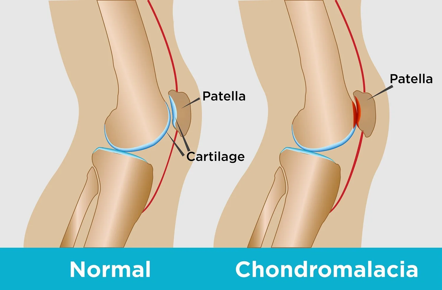 <p>softening and breakdown of the cartilage on the underside of the kneecap, causing knee pain and irritation</p><ul><li><p></p></li><li><p><strong>Chondro-</strong> = cartilage</p></li><li><p><strong>-malacia</strong> = softening</p></li></ul><p></p>