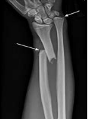 <p>What type of fracture is shown here? </p><p>-Distal radius fracture with radioulnar joint dislocation</p>