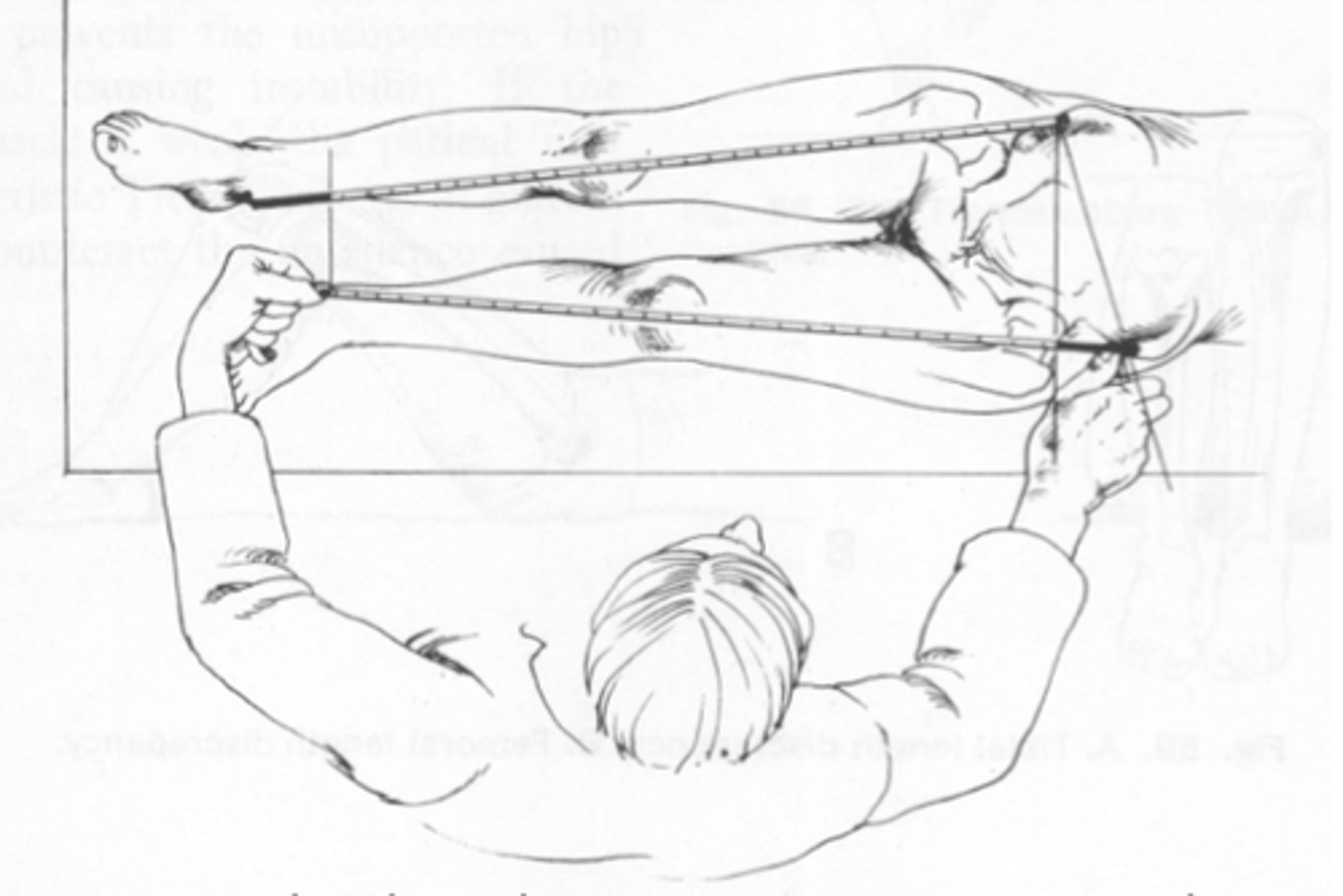 <p>True leg length discrepancy</p>