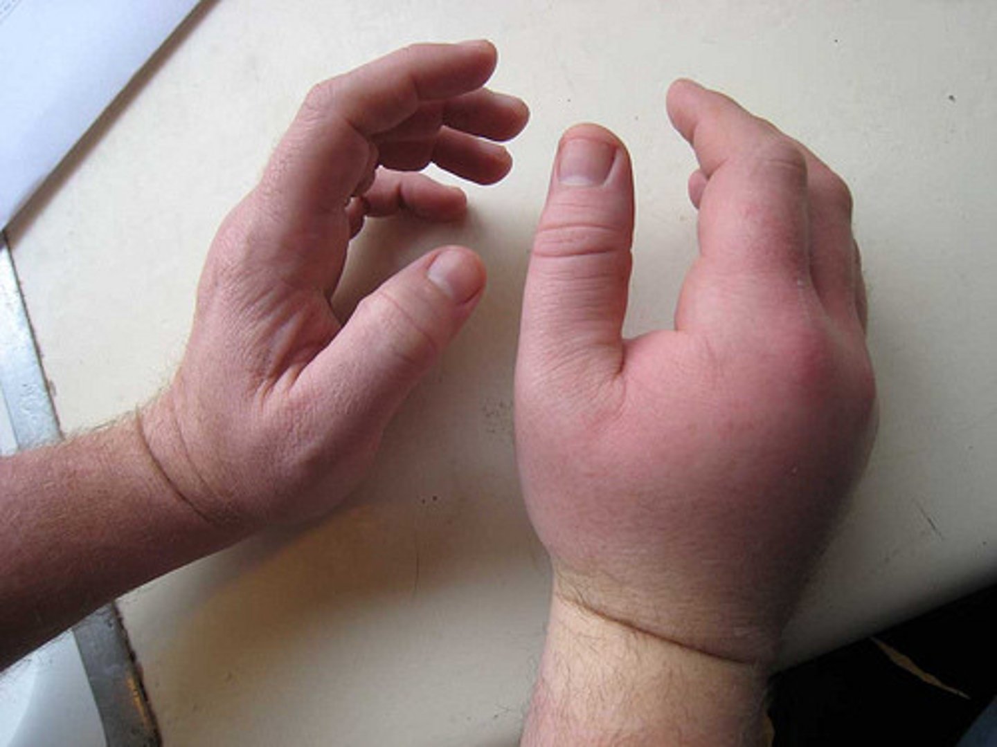 <p>inflamed</p>