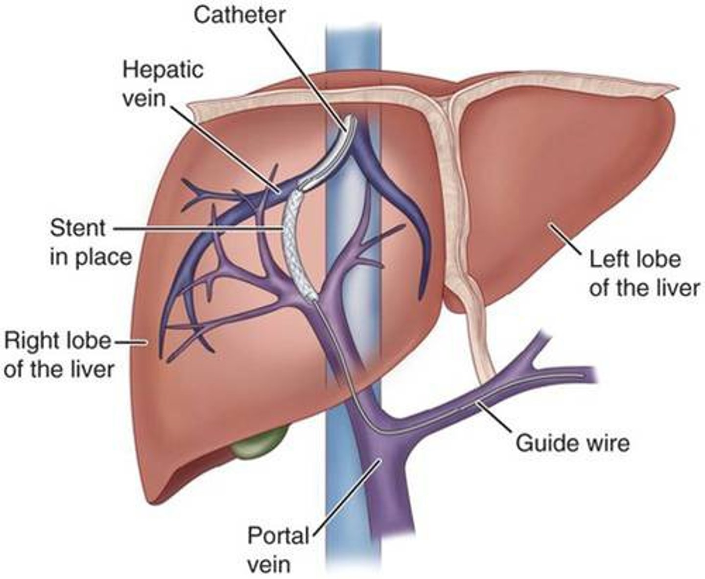 <p>Used to control long term ascites &amp; reduce variceal bleeding</p><p>Helps to DEC pressure in the hepatic vein by putting a shunt in it</p><p>Bc there is too much pressure in the portal vein, connect shunt into the hepatic vein to decrease the pressure</p><p>Post OP</p><p>→ FU US to check patency of shunt</p><p>→  used to treat portal hypertension </p><p>CX of procedure &amp; management</p><ul><li><p>Hepatic encephalopathy</p><ul><li><p>lactulose</p></li></ul></li><li><p>INC in PAP</p><ul><li><p>Diuretics </p></li></ul></li><li><p>Bleeding</p><ul><li><p>NG tube to assess bleeding</p></li><li><p>PRBC, plasma, dextran, albumin, platelets through 2 large bore IV catheters</p></li><li><p>**Monitor VS Q1H→ PT+PTT, INR &amp; platelet count. </p></li></ul></li></ul><p></p>