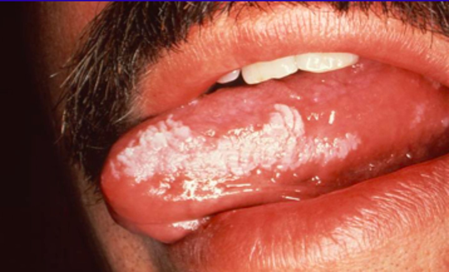 <p>Leukoplakia</p>