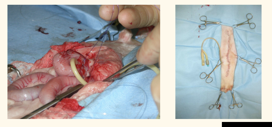 <p>A <strong>cranial midline coeliotomy</strong> is performed to access the stomach5 .</p><p>For gastropexy in GDV, a <strong>pyloric antrum gastrotomy</strong> is performed6 .</p><ul><li><p>A <strong>de Pezzer catheter (mushroom tipped)</strong> is commonly used as the gastrostomy tube5 ....</p><p>The tube is <strong>pulled through a tunnel in the left body wall</strong> (or right body wall for GDV according to one source6 )5 .</p><p>A <strong>purse-string suture</strong> is placed on the stomach wall, and a <strong>stab incision</strong> is made in the centre5 ....</p><p>The <strong>feeding tube is inserted into the gastric lumen</strong>, and the <strong>purse-string suture is tightened</strong> around the tube5 ....</p><p><strong>Pexy sutures</strong> are placed to secure the stomach to the abdominal wall5 ....</p><p>The tube is further <strong>secured to the body wall</strong>, often using a <strong>Chinese finger trap suture</strong>5 .... This helps <strong>prevent the patient from removing the tube</strong>5 .</p></li></ul><p>FIX THIS</p><ul><li><p>care: M dog: cauda; epigastric + retractor penis m.</p></li></ul><ol><li><p>foley catheter</p></li><li><p>purse-string in urinary baldder→ stab purse string</p></li><li><p>tighten purse string</p></li><li><p>tacking suture: bladder and body wall</p></li></ol><p></p>