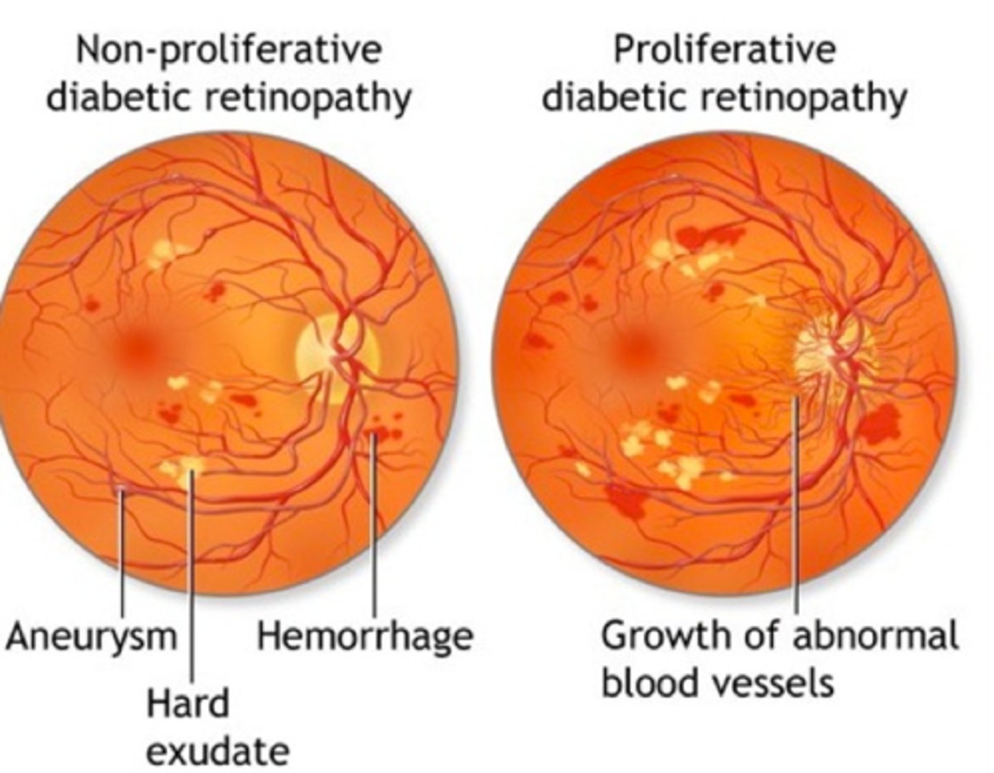 <p>Proliferative and nonproliferative retinopathy.</p>