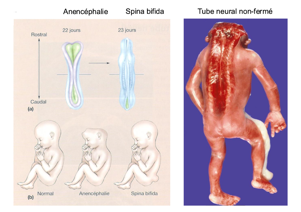 <p>→ Anencéphalie <br>→ Spina bifida<br><span>⇒ une malfermeture du tube neurale entraîne des conséquences létales pour l’embryon </span></p>