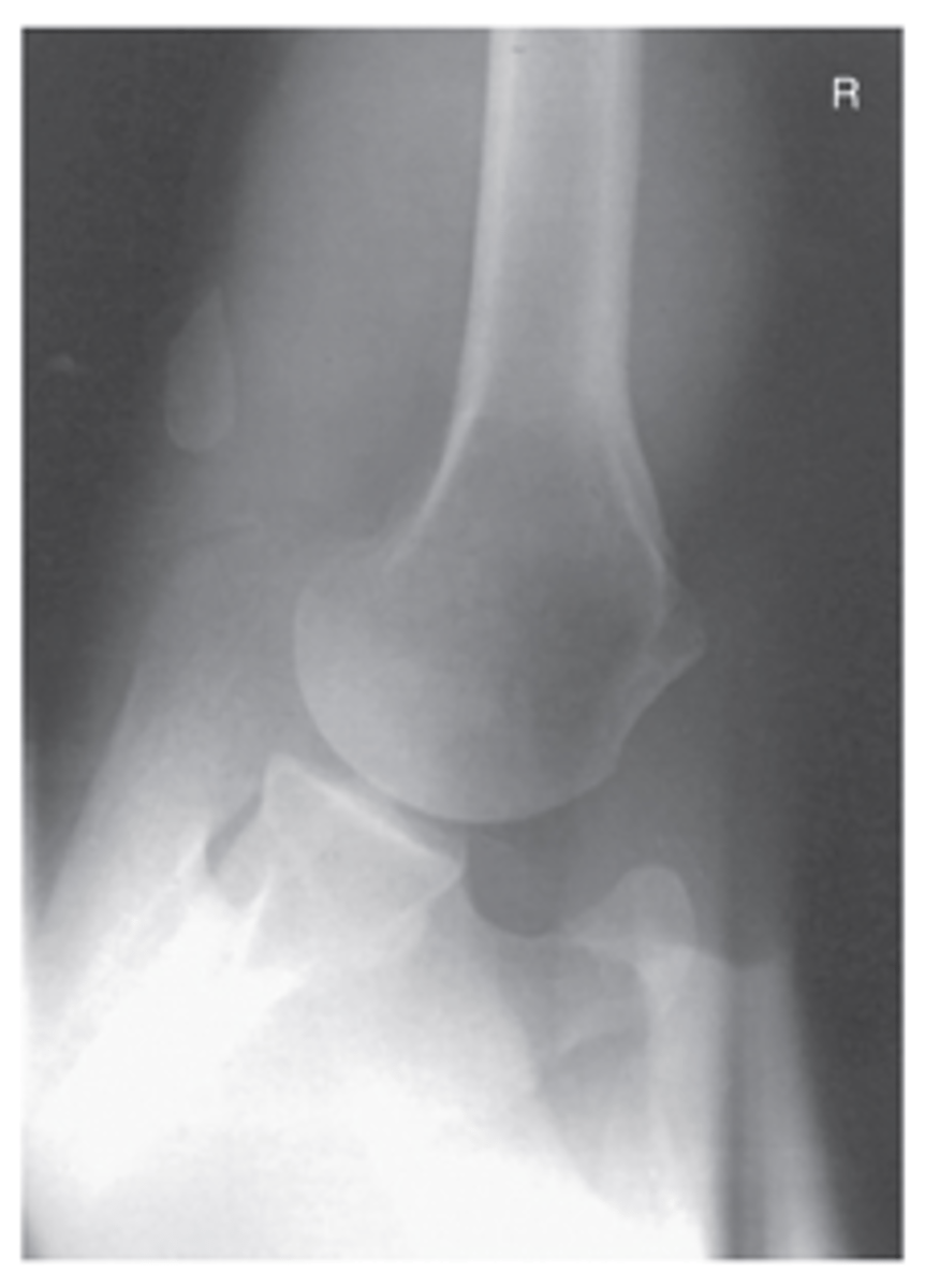 <p>- CR perpendicular to IR</p><p>- If patient cannot abduct arm, CR 5° to 15° to axilla</p>