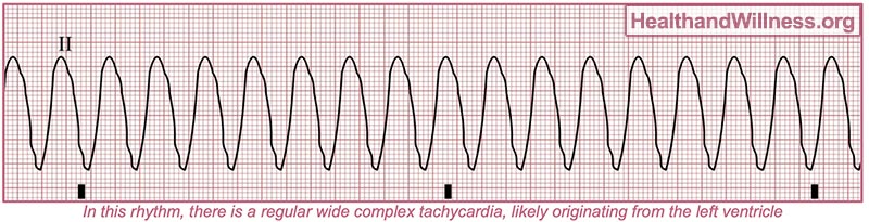 <p>very fast heart rythm </p>