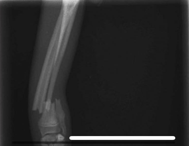 <p>the radiograph shows a direct fracture of the tibia and fibula True False</p>
