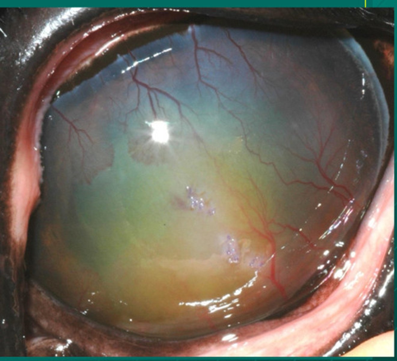 <p>What is the name of this deep fibrovascular reactivity and edema, where depth is indicated by green fluid filling up the stroma and capillary leakage:</p><p>a. immune mediated epithelial keratitis</p><p>b. chronic SUPERFICAL stromal immune mediated keratitis</p><p>c. chronic RECURRENT DEEP stromal immune mediated keratitis</p><p>d. eosinophilic keratitis</p><p>e. immune mediated endothelitis</p>