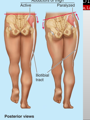 <p>An abnormal gait from weak hip abductors (gluteus medius/minimus). During stance, pelvis drops on the unsupported side (during single leg); trunk leans to the affected side to maintain balance</p>