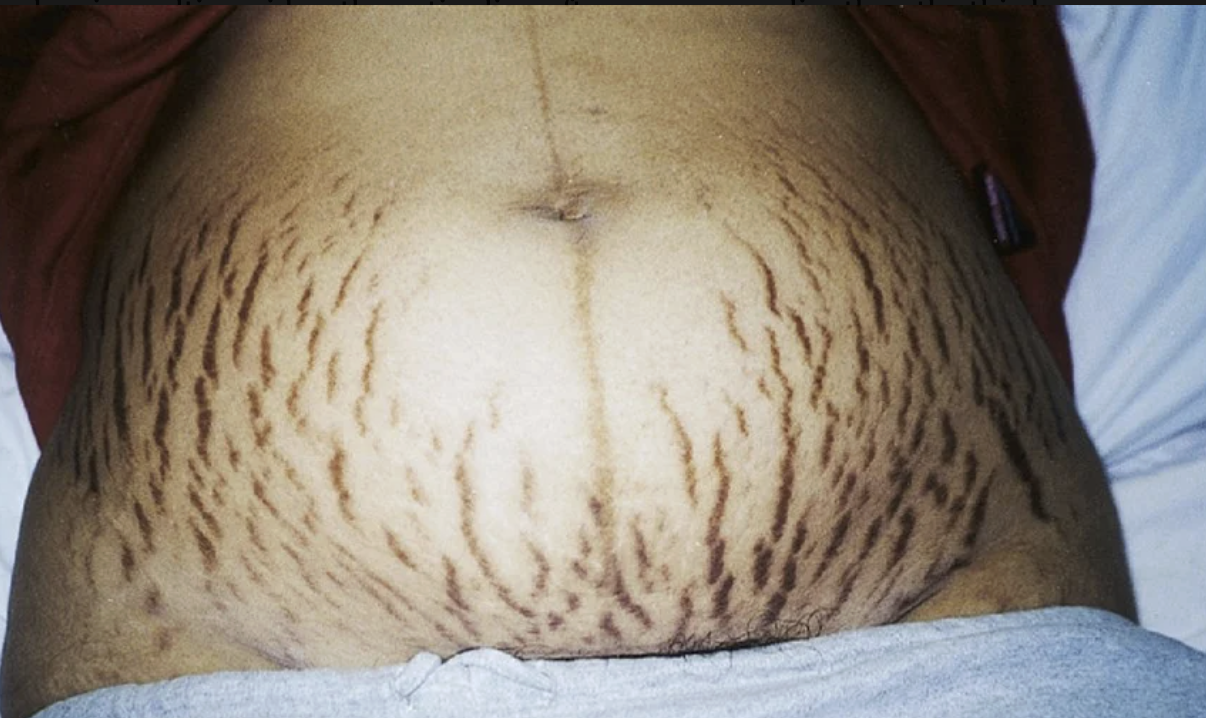 <p>pigmented line extenting from the symphysis pubis to the top of the fundus in the midline. linea alba before hormone-induced pigmentation</p>