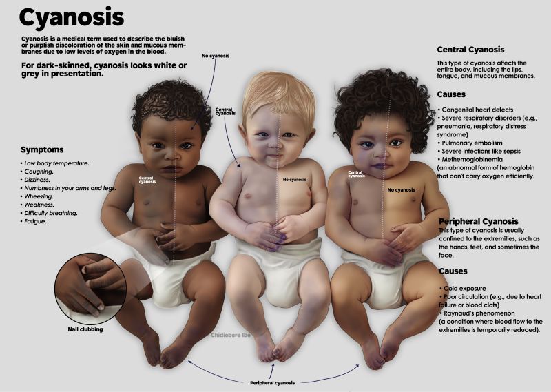 <ol><li><p>light skin: bluish-purplish skin tone (most look like cyan)</p></li><li><p>dark skinL grayish or whiteish (some blueish hue) </p></li></ol><p></p>