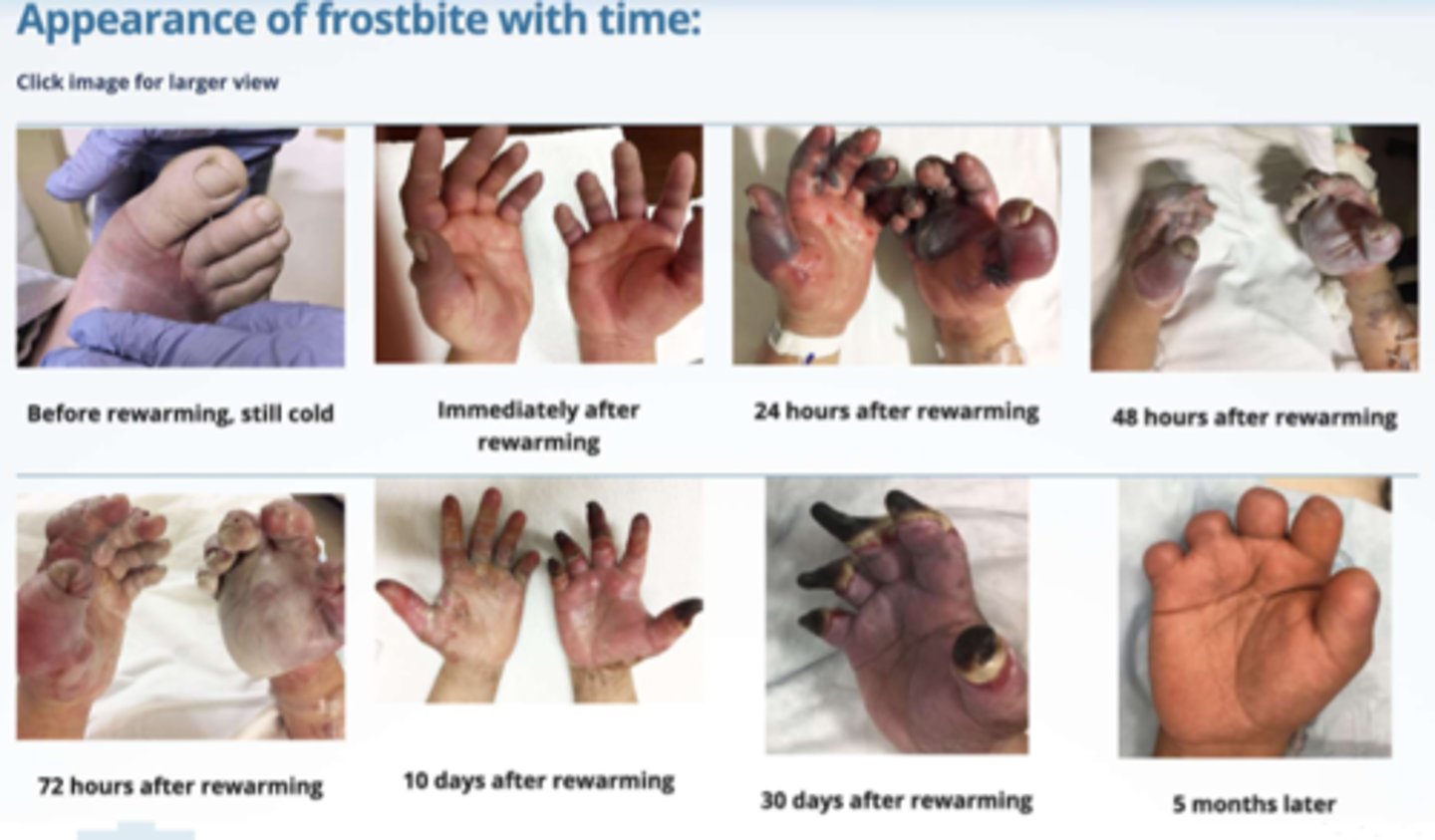 <p>- NSAIDs (eg. Ketorolac IV, Ibuprofen) => need to address inflammation BEFORE/during rewarming to avoid reperfusion injury &amp; therefore further damage</p><p>- analgesics => opioids (eg. Morphine, Hydromorphone) (*body will have a harder time healing in stress/pain!)</p><p>- abx => prophylactic use (prevents infection in cases with tissue necrosis) (eg. cephalexin, clindamycin, zosyn)</p><p>- thrombolytics: agents like tPA (eg. alteplase) may be considered to restore blood flow in severe cases if clotting occurs (dissolving the clot)</p>