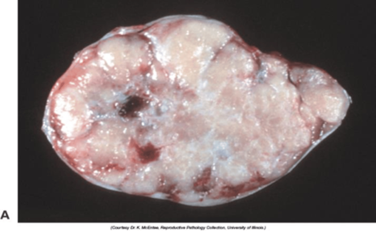 <p>- Firm white to brown lobulated mass</p><p>- Fibrous</p><p>- Cysts</p><p>- Testicular enlargement</p>