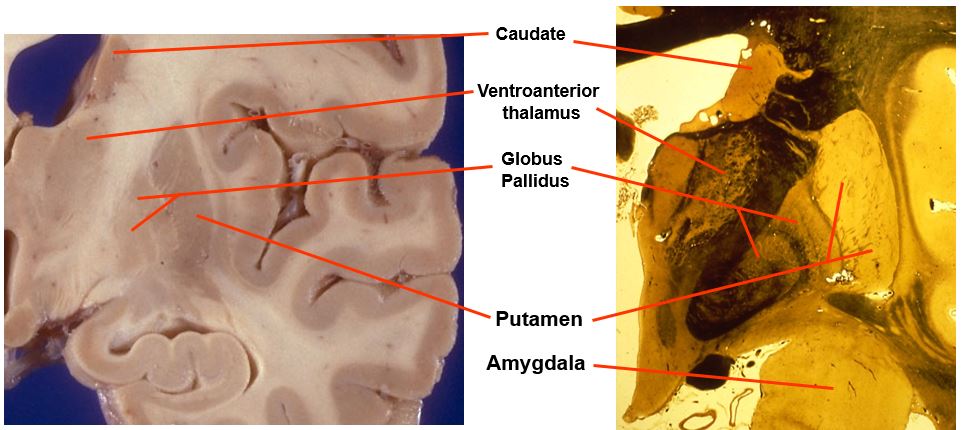 <p>includes:</p><ul><li><p>caudate</p></li><li><p>ventroanterior thalamus</p></li><li><p>globus pallidus</p></li><li><p>putamen</p></li><li><p>amygdala</p></li></ul><p></p>