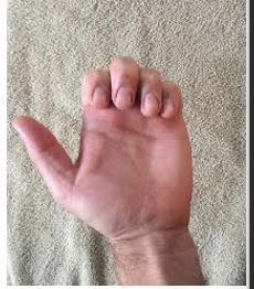 <p>Extension of wrist, fingers and thumb. When retraining, finger intrinsic substitution (lumbricals) can be a problem. Use coban to isolate the extensor digitorum. </p>