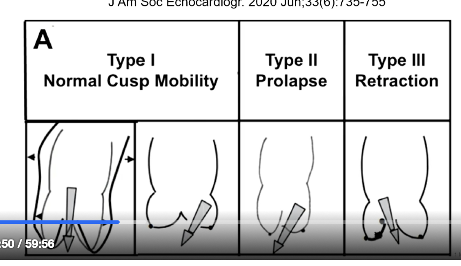 <p>prolapse</p>