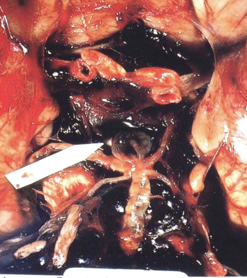 <p>Congenital saccular dilation of cerebral arteries that can rupture causing subarachnoid hemorrhage.</p>